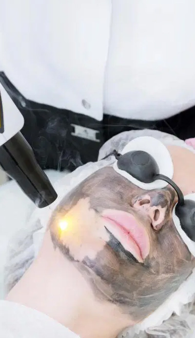 acne-treatment-toronto-services-seemas-laser 333w